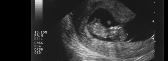 ultrasound, 10 wks